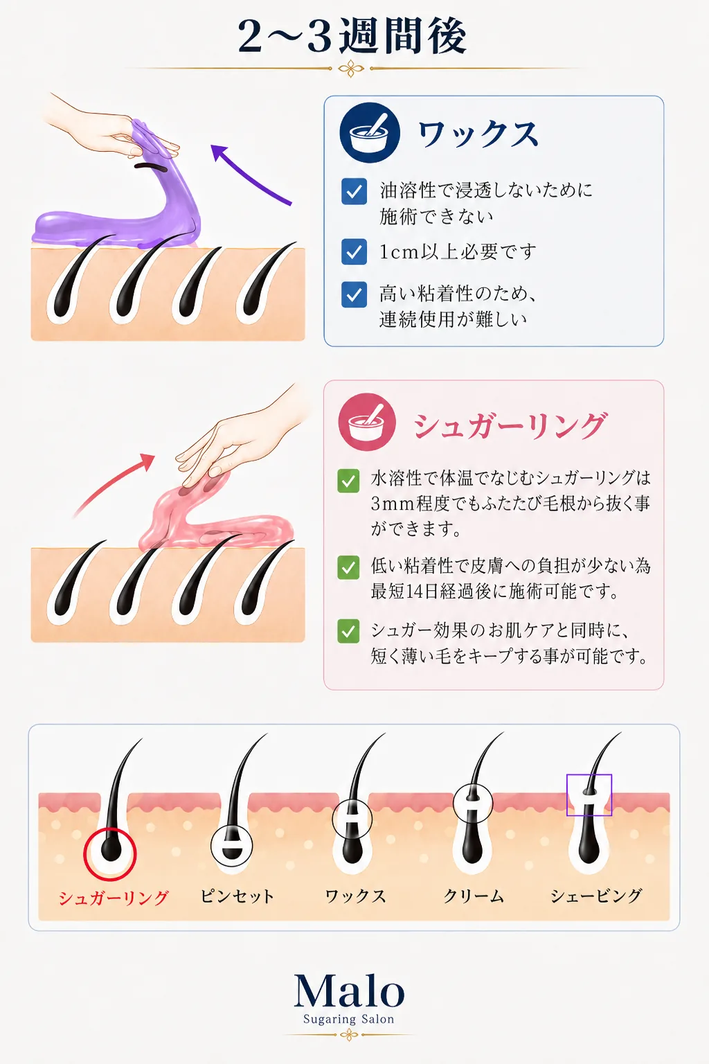 施術2〜3週間後の毛の状態:ワックスとシュガーリングの違い、および脱毛方法の比較